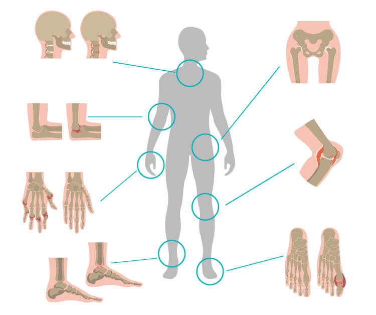 再生医療でアプローチできる関節部位を示した人体図