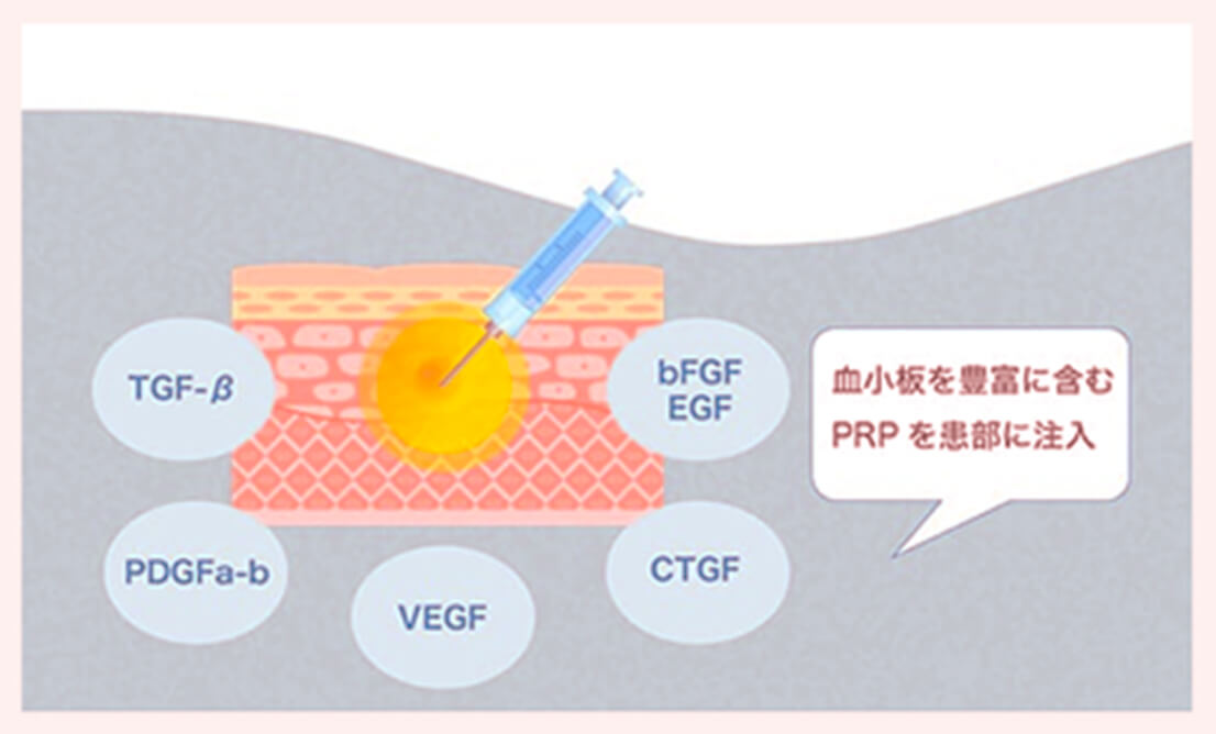 PRPに含まれる成長因子（TGF-β・bFGF・EGF・PDGFa-b・VEGF・CTGF）が患部に作用する仕組みを示した図解