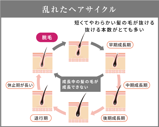 AGAによる乱れたヘアサイクルの図解。短くやわらかい髪が多く抜け、成長中の髪が成長できない状態を示す