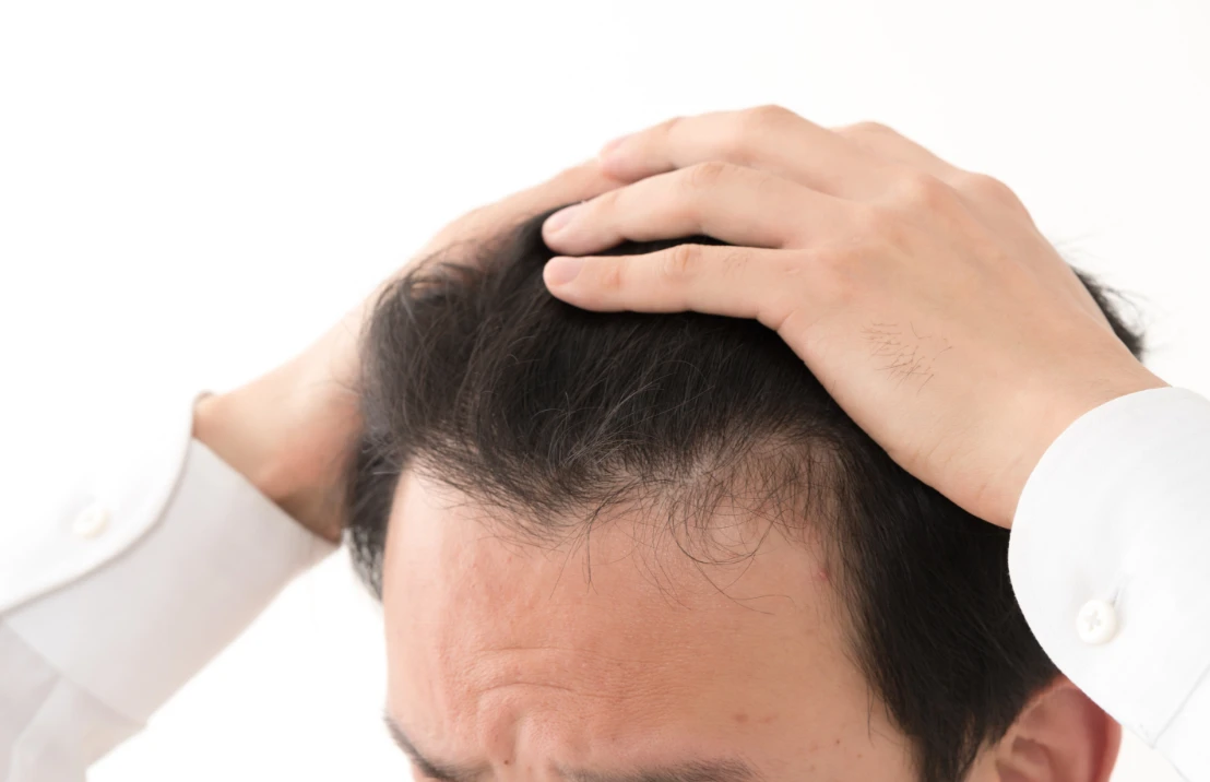 AGAによる薄毛が進行した男性の頭部