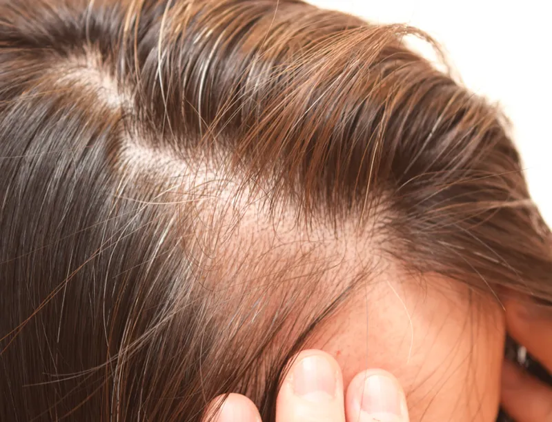 びまん性脱毛症による薄毛が進行した女性の頭部
