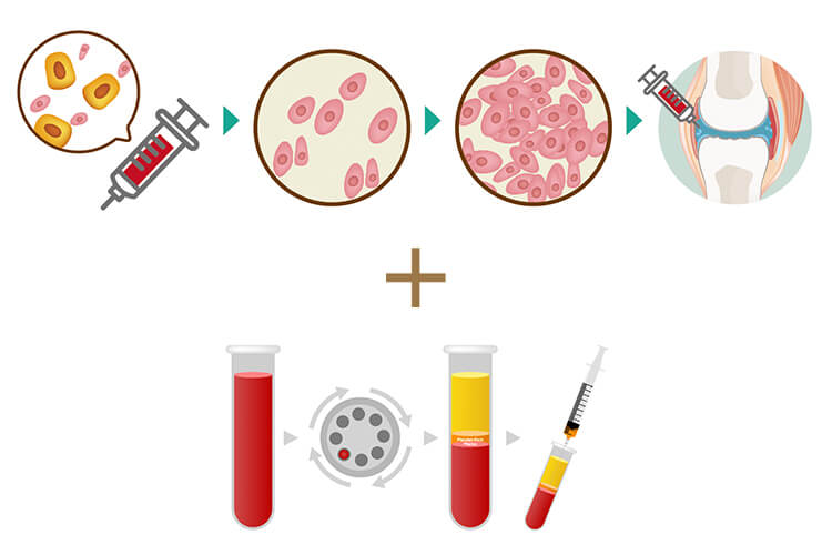 幹細胞治療とPRP治療を組み合わせた治療の流れを示すイラスト