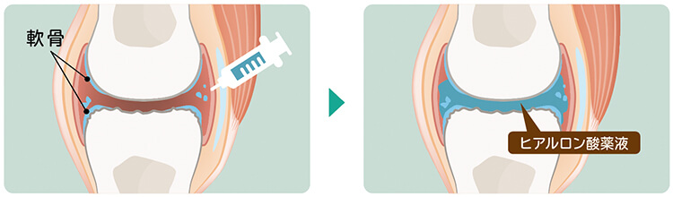 ヒアルロン酸注射による関節治療の仕組みを示すイラスト