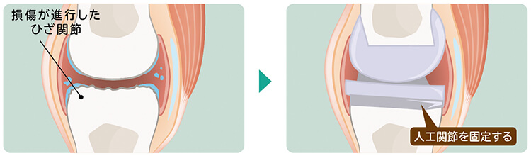 人工関節置換術の仕組みを示すイラスト