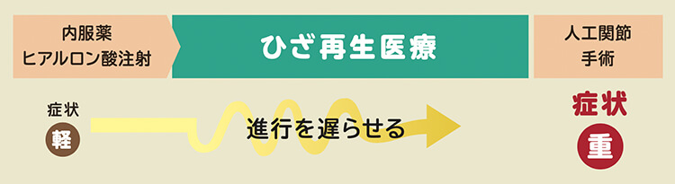 再生医療により変形性関節症の症状進行を遅らせられることを示す図解