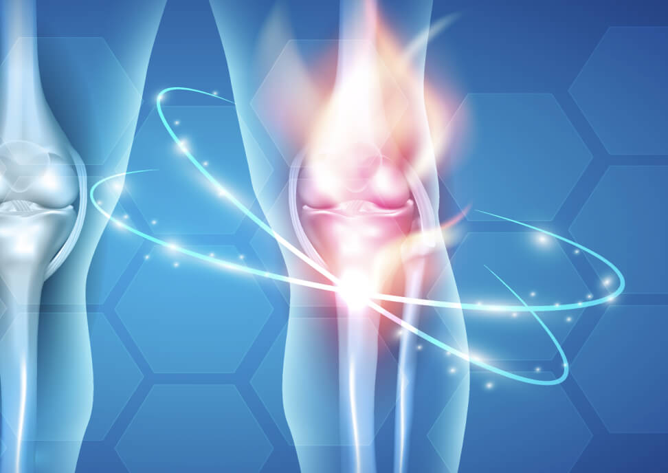 膝関節の炎症・損傷を表すイラスト