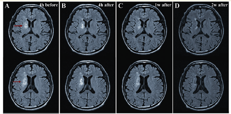 幹細胞治療後の脳のMRI観察写真