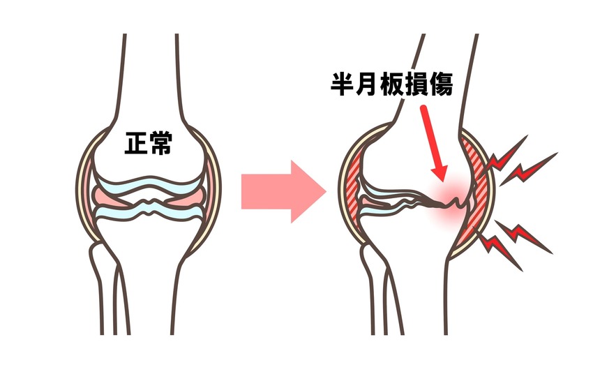 半月板損傷